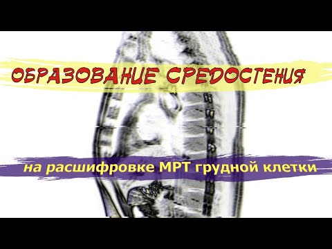 ОБРАЗОВАНИЕ средостения (ТИМОМА и ее диагностика) на РАСШИФРОВКЕ МРТ грудной клетки