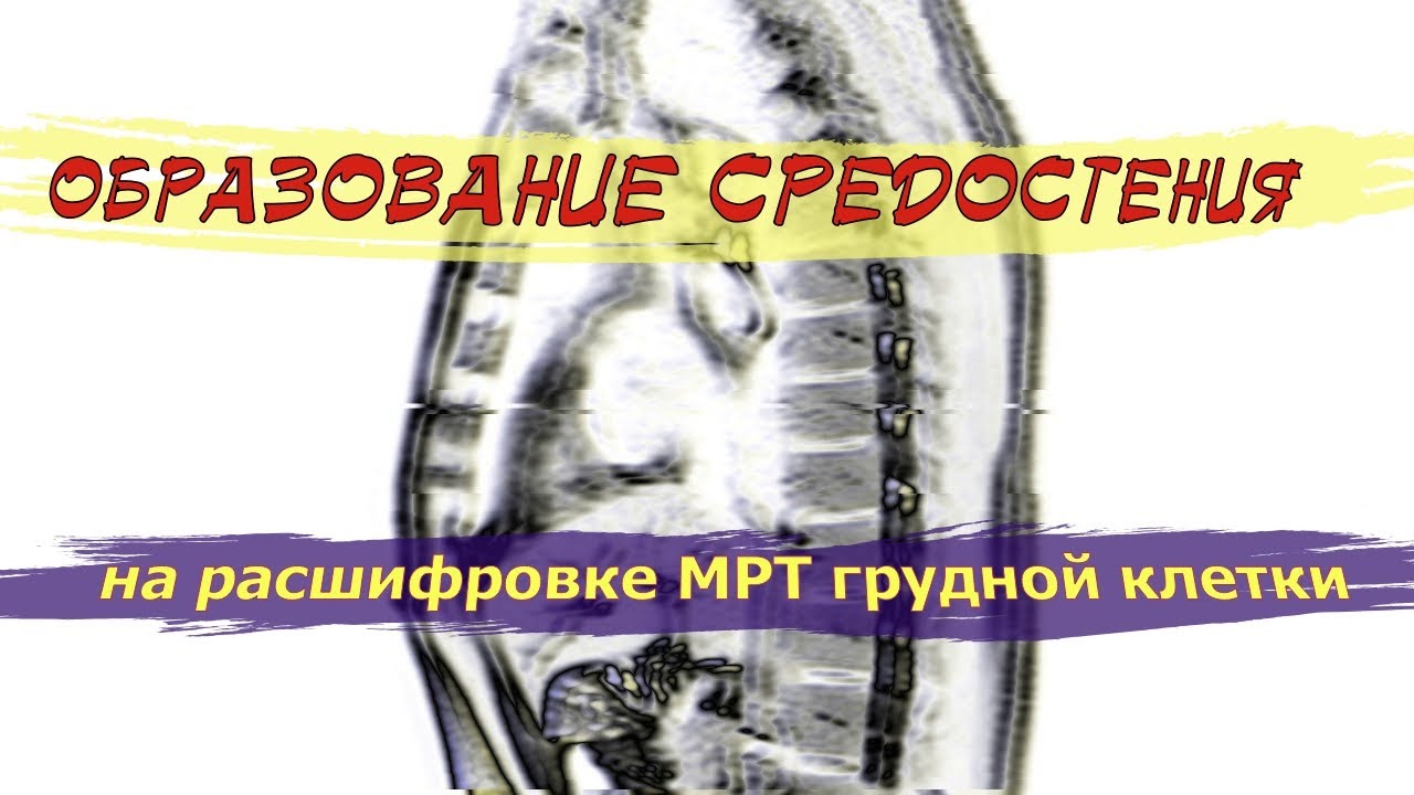 ОБРАЗОВАНИЕ средостения (ТИМОМА и ее диагностика) на РАСШИФРОВКЕ МРТ ...