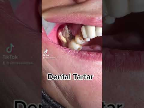 Dental Cleaning, Dental Scaling #tiktok #viral #video #fyp #funny #love #dentist