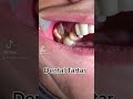 Dental cleaning dental scaling tiktok viral fyp funny love dentist