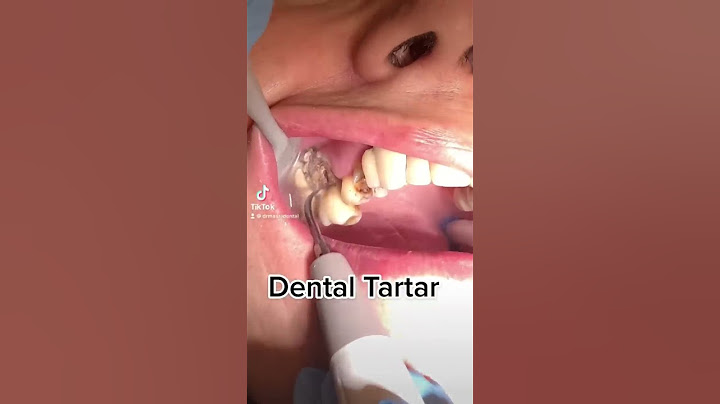 Dental Cleaning, Dental Scaling #tiktok #viral #video #fyp #funny #love #dentist