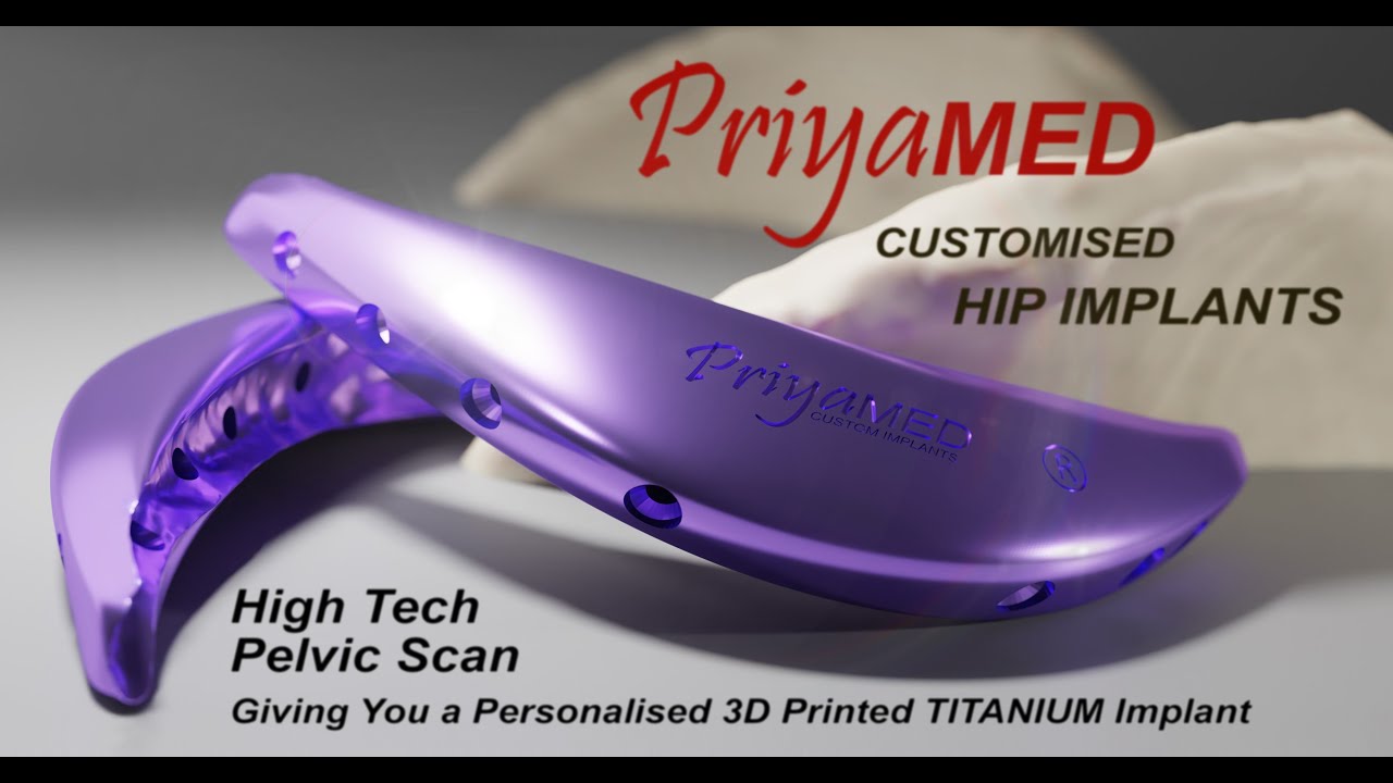 PriyaMED presents... Meet the CURVE Custom 3D Printed Titanium Iliac