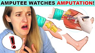 Amputee Watches AMPUTATION SURGERY!