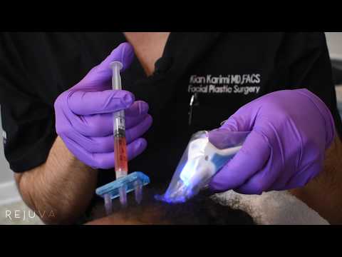 Hair Growth Treatment Platelet Rich Fibrin Injections (PRF) with Dr. Kian Karimi