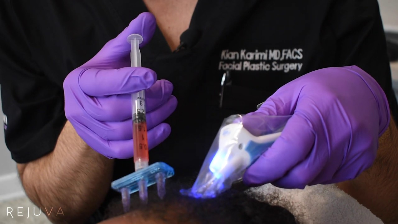 Hair Growth Treatment Platelet Rich Fibrin Injections (PRF) with Dr. Kian  Karimi - YouTube