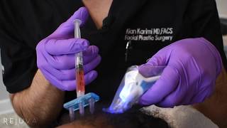 Hair Growth Treatment Platelet Rich Fibrin Injections (PRF) with Dr. Kian Karimi