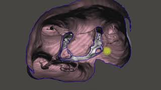 Maxillary First Molar Decomposition, Micro-Computed Tomography(MCT) dataset, Meshmixer