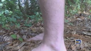 Human Case Of Eastern Equine Encephalitis Confirmed In Mobile County