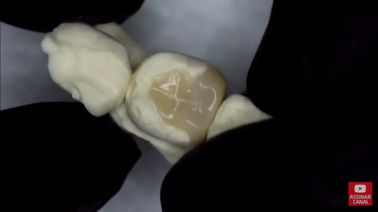 Onlay passo a passo - Restauração indireta de resina composta