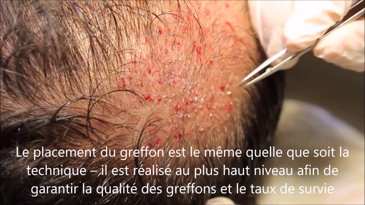 Les Techniques de Greffe Capillaire FUT