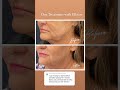 Non Surgical Face Lift Ellacor