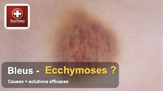 Ecchymoses Comprendre Ces Marques Bleues