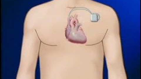 Defibrilador Automatico Implantable