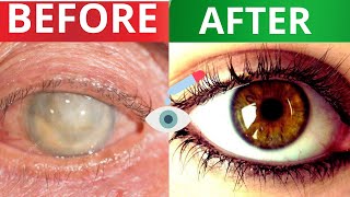 The #1 Remedy for Cataracts | Restore your eyes