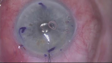 DMEK graft start to finish with commentary