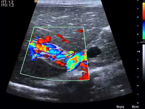 CAVERNOMATOSIS PORTAL