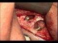 Dr jason deblinger root canal surgery microscopic apicoectomy lower molar microapicoectomy