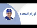 All About Stomach Cancer Gastric Cancer Dr Osama Hamed 