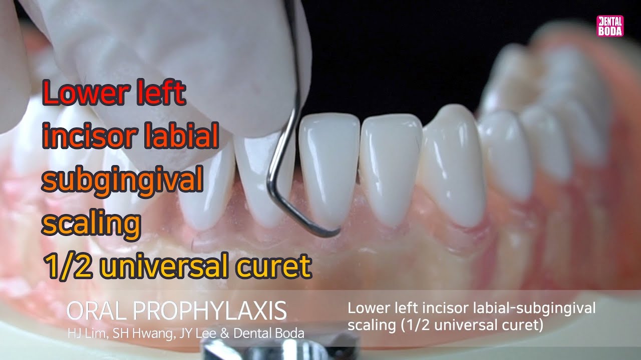 Lower left incisor labial subgingival scaling 1/2 universal curet YouTube