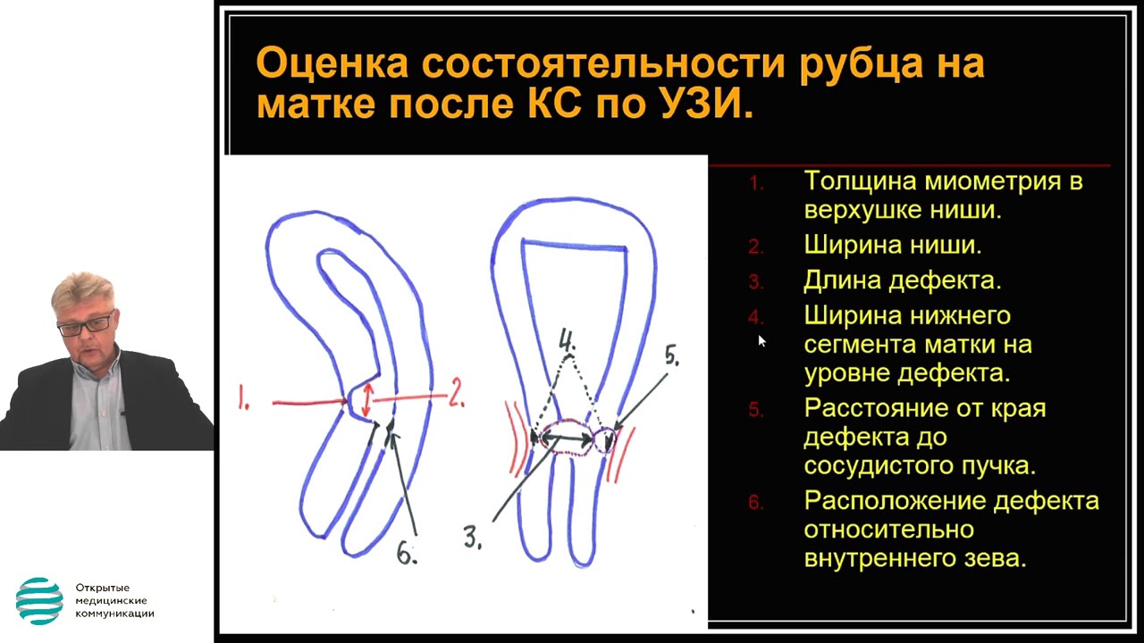 Узи шов кесарево. Рубец на матке после КС на УЗИ. Оценка состоятельности рубца на матке. Несостоятельность рубца. Несостоятельность рубца УЗИ.