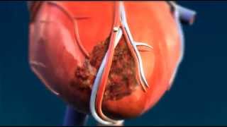 Heart Tissue Scarring