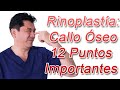 12 Puntos Importantes Sobre El Callo Óseo - Rinoplastía