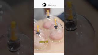 Flexion Distraction combined with Cupping Therapy! #backpain #chiropractic #recovery