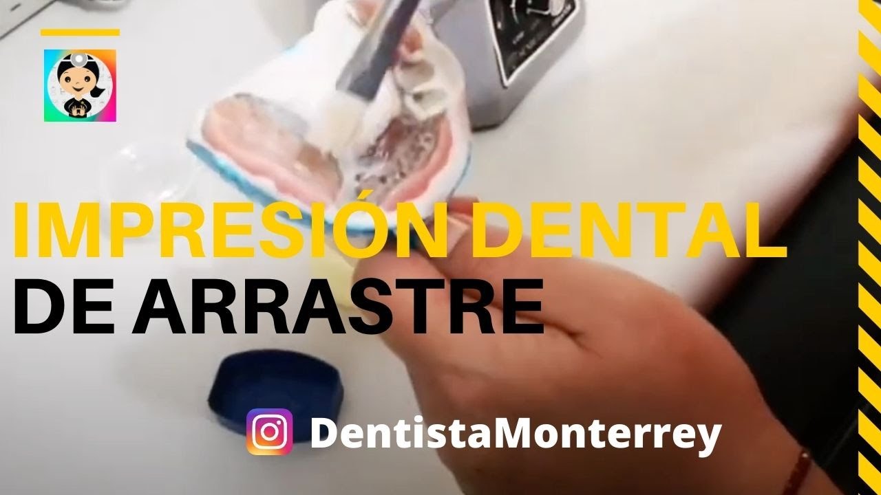 Impresión DENTAL de ARRASTRE  Pick-Up 👅Cómo se Corre en YESO❓