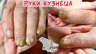Зачистка ногтя при грибке / Подготовка ногтей к лечению