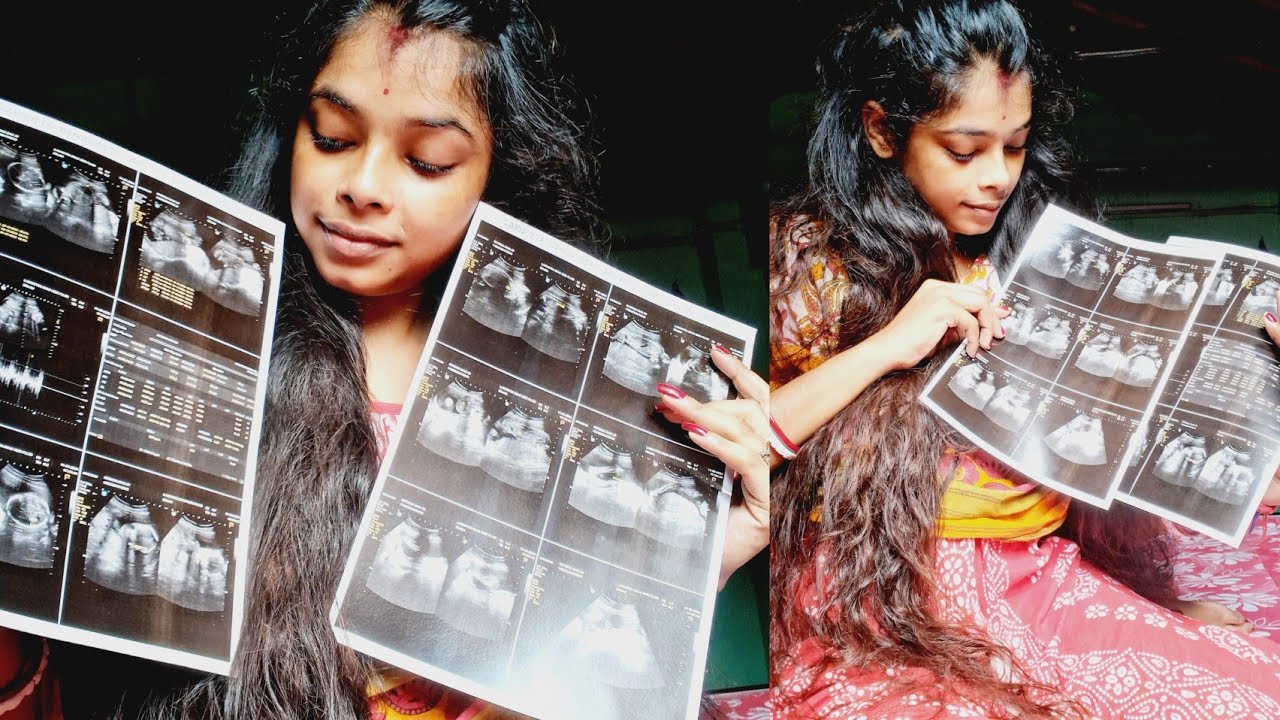 anomaly scan কি সত্যিই বোঝা যায়। । আমার ছেলে হবেকি মেয়ে।।