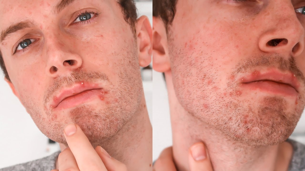 Acne is Normal YouTube