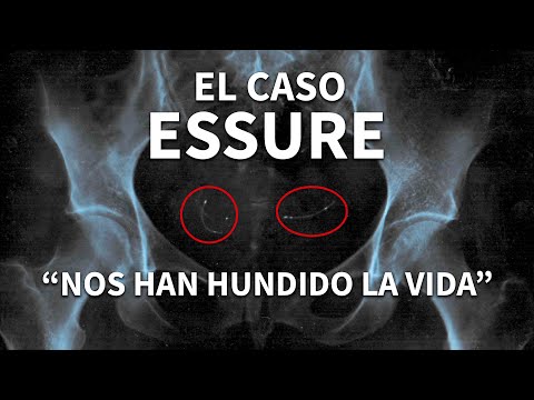 Violencia ginecológica - El anticonceptivo Essure