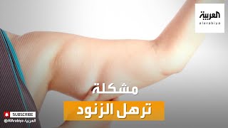 صباح العربية | كيف نتعامل مع مشكلة ترهل الزنود؟