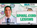 Spinal Cord Lesions: Anterior Cord, Posterior Cord, Central Cord, Brown-Sequard