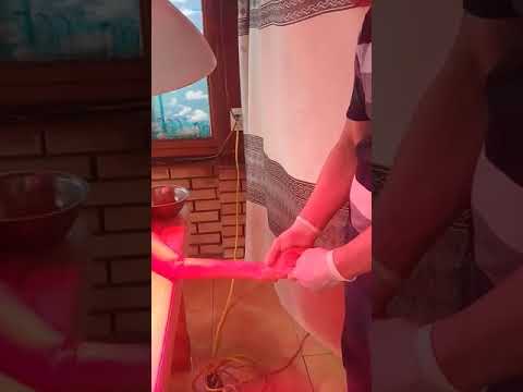 Ngày thứ 2 điều trị Xơ Cột Bên Teo Cơ cho bệnh nhân Nguyễn Thị Hương