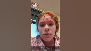 Harper’s Monster Zit!