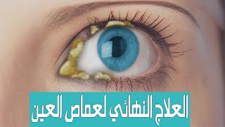 علاج عماص وافرازات العين بشكل نهائي