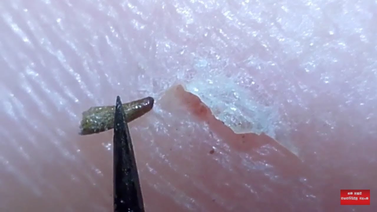 Blackberry thorn removal. YouTube