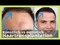 Meine 3 Haartransplantationen: Vergleich Deutschland vs. Türkei