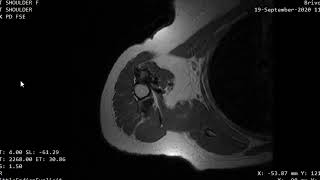 CASE 1130  MRI arm myositis ossificans