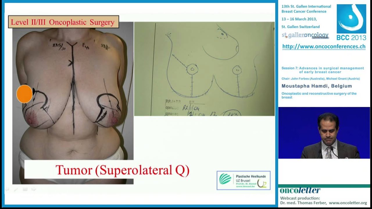 oncoplastic and reconstructive surgery of the breast Oncoplastic and reconstructive surgery of the breast