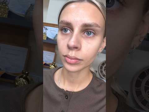 Выведение филлера из носослезной борозды и моментальный результат #косметологростов