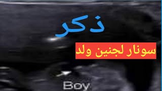 سونار يوضح جنين ذكر/شرح جنين ولد فى السونار