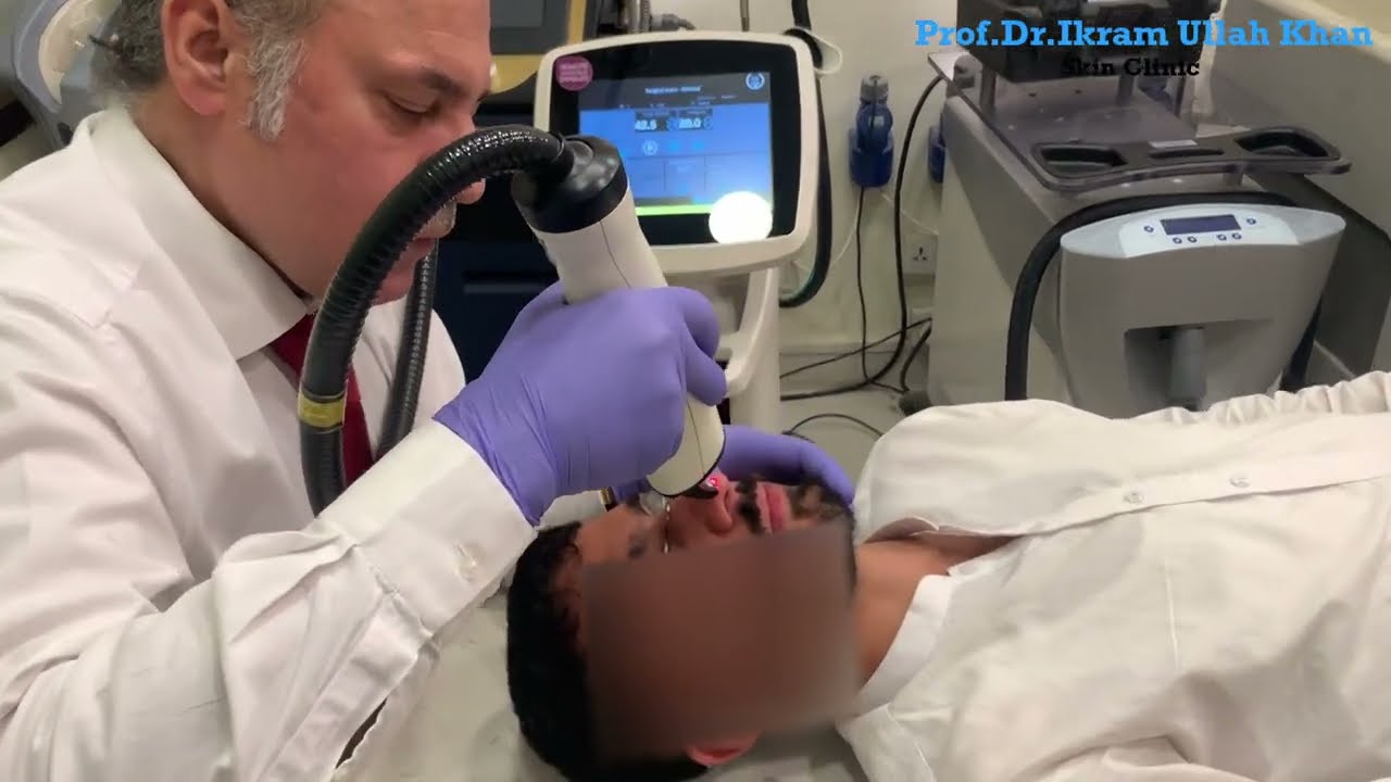 Unbelievable Scar Disappearance! Erbium Glass Laser Treatment 