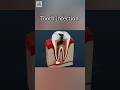 tooth infection 🦷 #dentist #teethdecay #teeth