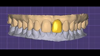 How to COPY / MIRROR tooth design in exocad for upper anterior tooth ?