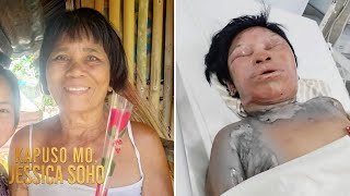 Babae, nasunog ang balat dahil umano sa ginamit niyang hair dye o tina?! | Kapuso Mo, Jessica Soho