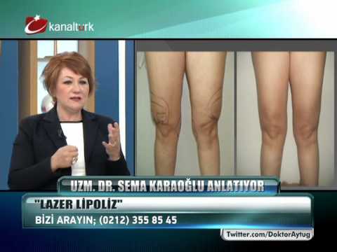 Uzm. Dr. Sema Karaoğlu - Lazer Lipoliz Nasıl Uygulanır - Kanalturk