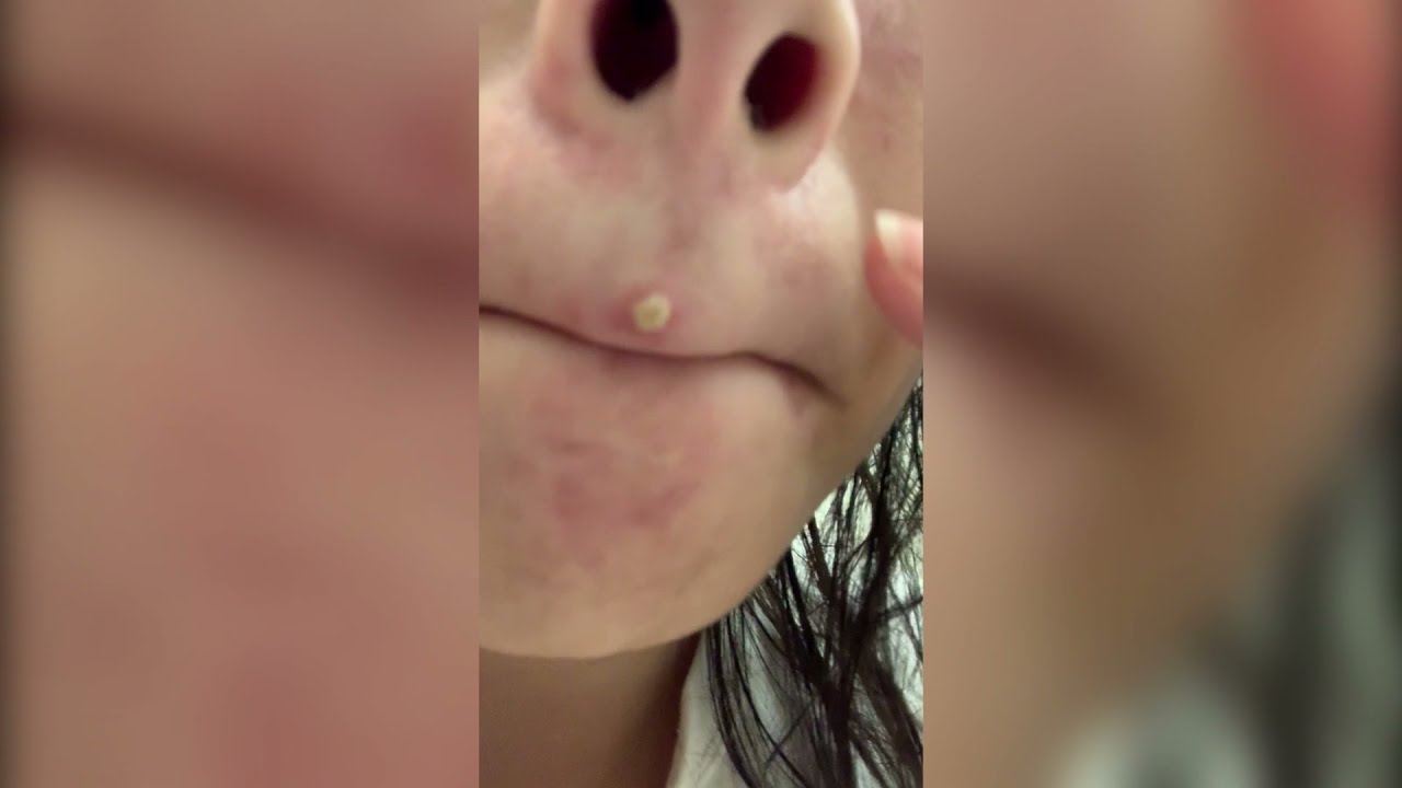Popping huge blackheads and Pimple Popping - Best Pimple Popping Videos #12