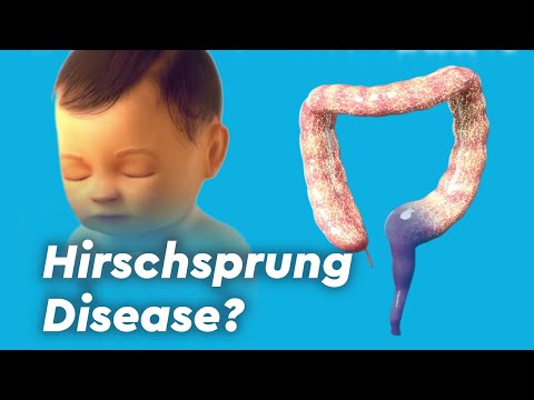 Video: Hirschsprungs Sjukdom - Symtom, Behandling, Kirurgi